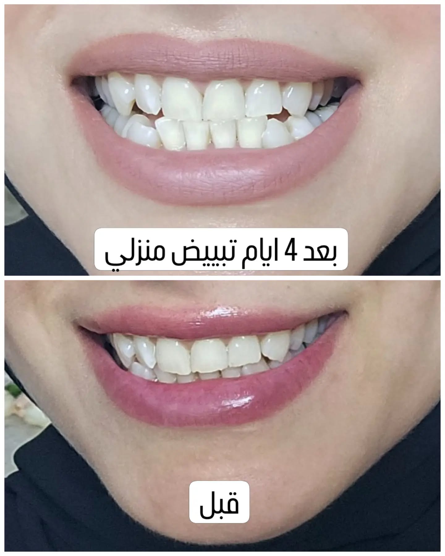 حالة تبييض منزلي من العيادة: النتيجة في الأعلى والصورة قبل العلاج في الأسفل